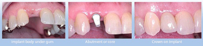 Figure 6 | Dental Implant Posts (Photo Credit: Dentist in Goa via Flickr)